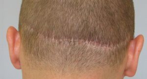 Hair Transplant Scars