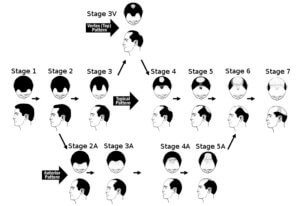 norwood-scale-7-stages-of-hair-loss