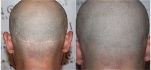 Scar before and after