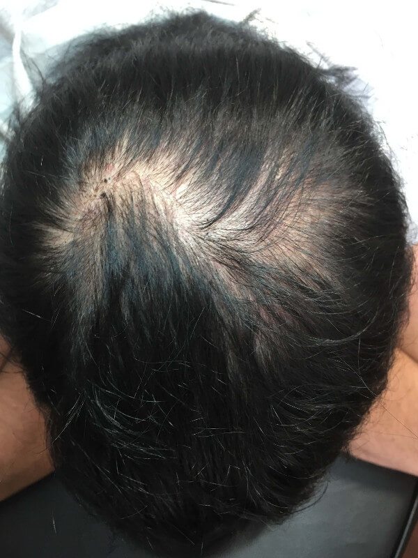 AC Hair Loss - FULL Micropigmentation