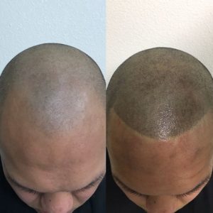 What is SMP - Scalp Micropigmentation