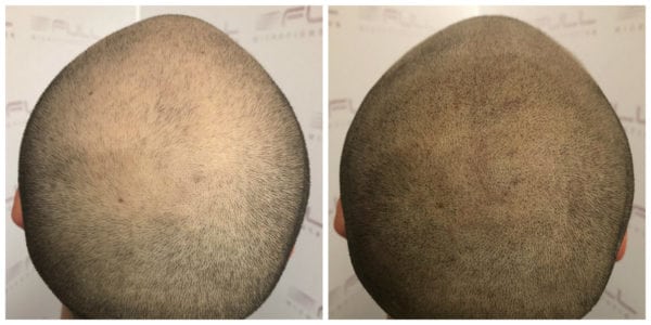 Jacob BA back - Scalp Micropigmentation - Las Vegas