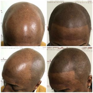 Major Hair Loss - EC