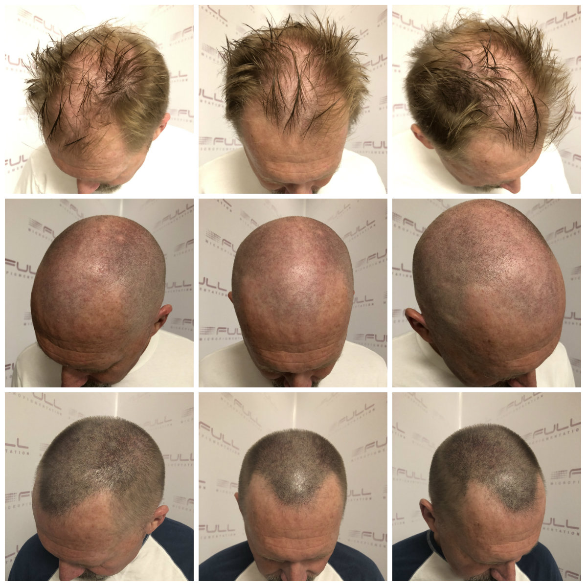 See how SMP transforms thinning hair into a FULL head! - FULL ...