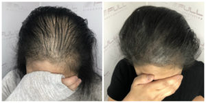 Scalp Micropigmentation For Women - FULL Micropigmentation