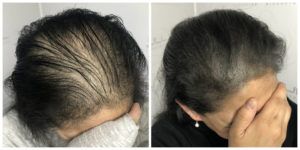 Scalp Micropigmentation For Women - Full Micropigmentation