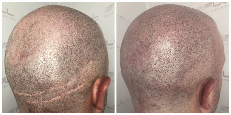 Hair Transplants vs Scalp Micropigmentation! - FULL Micropigmentation