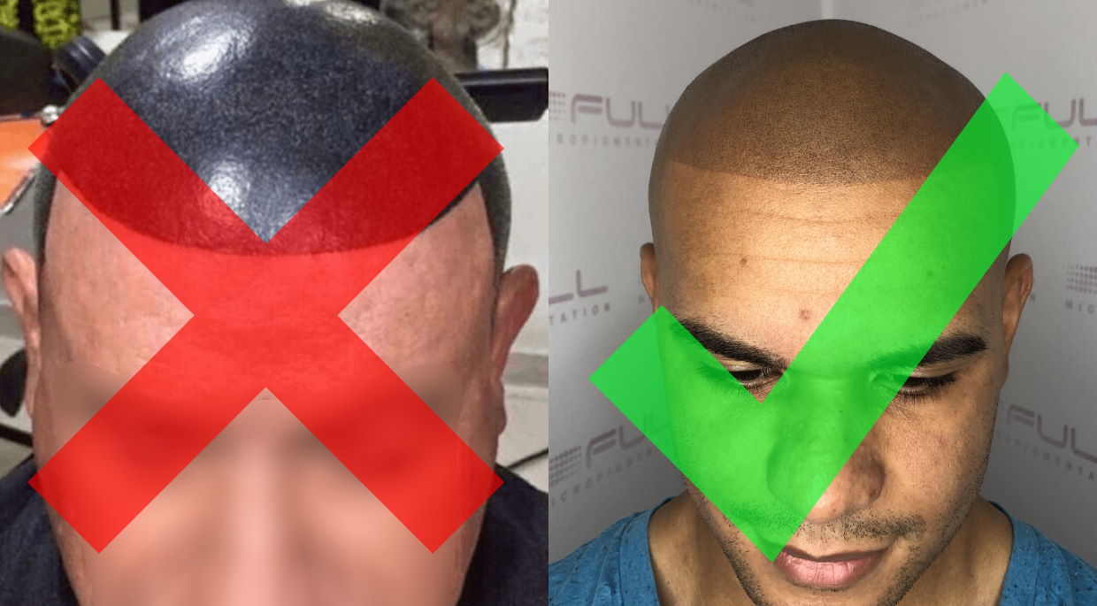 Navigating Scalp Micropigmentation Regrets: Expert Advice