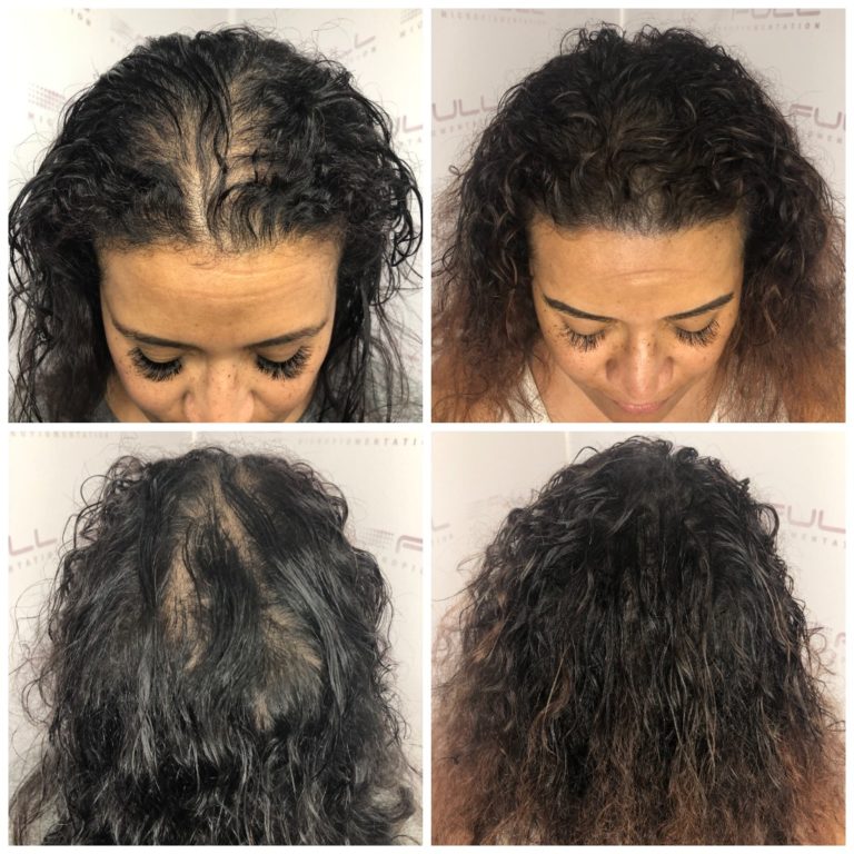 Thinning Hair Solution - FULL Micropigmentation