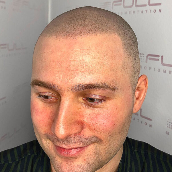 Brandon after Scalp Micropigmentation