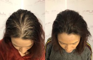 Hair Loss Treatment For Women